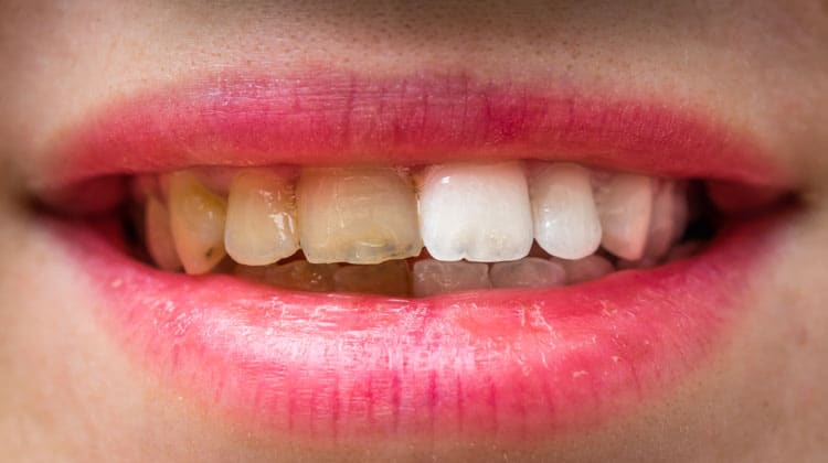 how to get white teeth